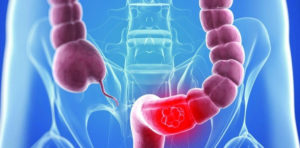 témoignage survie longue cancer prostate métastase mod neconvențional de a trata prostatita