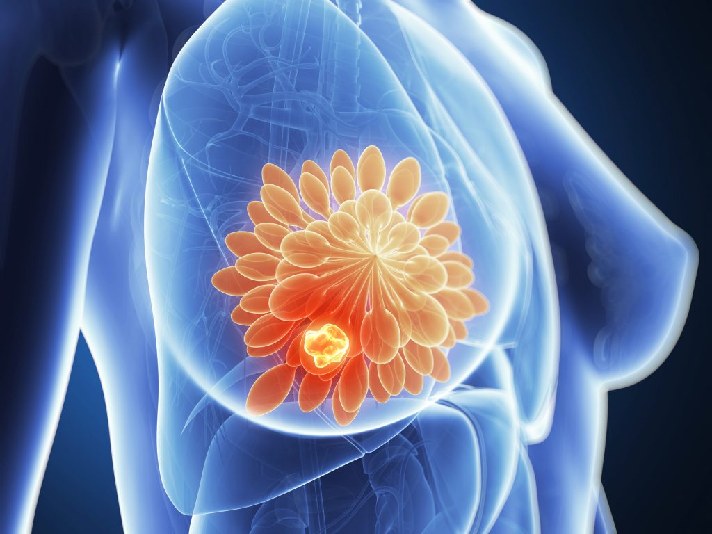 Cancer du sein suivi de tumeur pulmonaire et métastases cérébrales ...